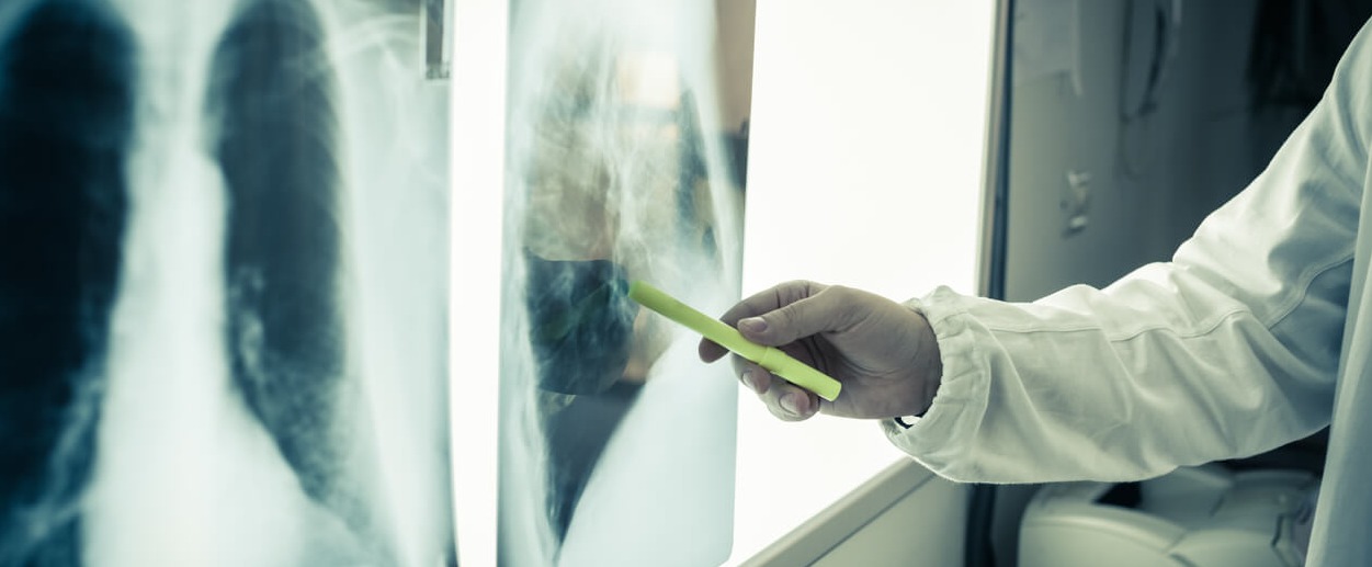 idiopathic-pulmonary-fibrosis idiopathic-pulmonary-fibrosis