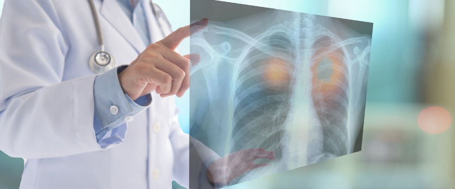 Doctor examines X-ray for small cell and non-small cell lung cancer
