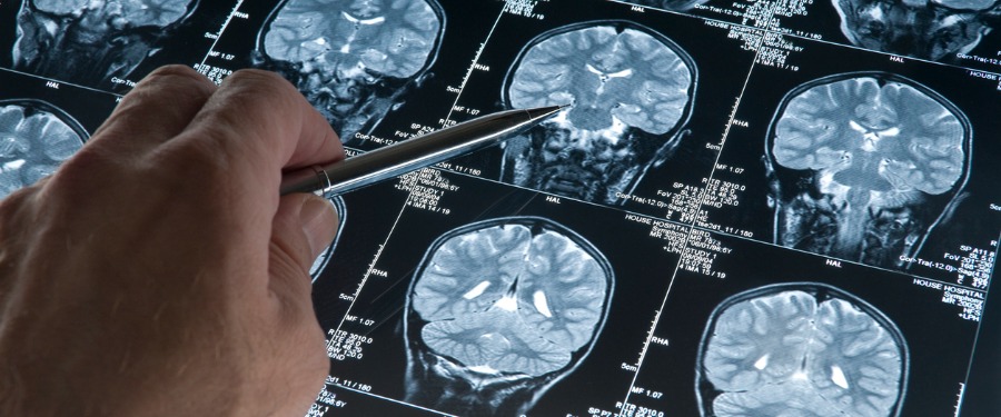 Doctor examining brain scans of Alzheimer’s patient Doctor examining brain scans of Alzheimer’s patient