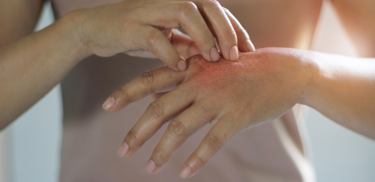 A 71-year-old female came with complaint of itching and eczema